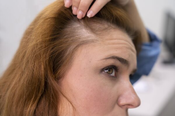 Baricytynib przyszłość skutecznego  leczenia łysienia plackowatego